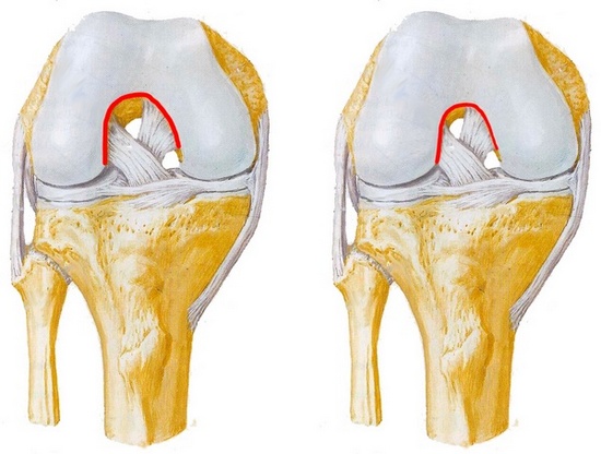 Крестообразная связка колена фото