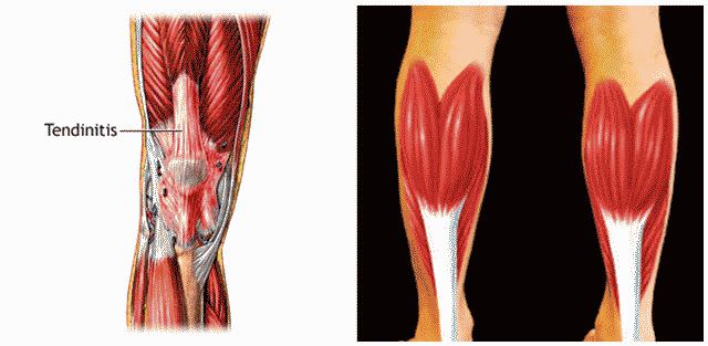 Тендинит коленного сустава фото