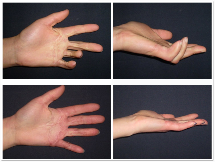 Реабилитация пальца после операции. Травматические сухожильные контрактуры. Ладонный фиброматоз (контрактура Дюпюитрена). Десмогенная контрактура.