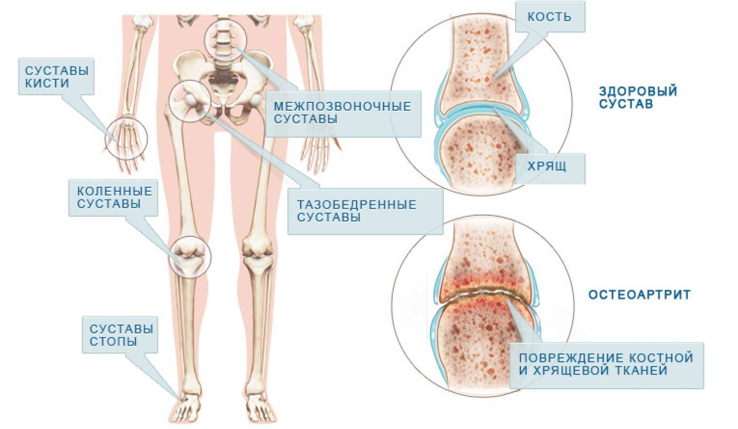 Поражение крупных суставов. Симптомы поражения суставов ревматоидного артрита. Ювенильный ревматоидный артрит колени. Ревматоидный артрит суставной симптомы. Ювенильный ревматоидный артрит ног.