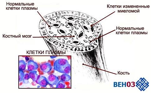 Vrd схема миелома - 89 фото