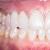 Ελαττώματα στην οριακή εφαρμογή των οδοντοστοιχιών