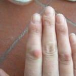 Deformação das articulações dos dedos: tratamento da curvatura A deformação das articulações dos dedos causa
