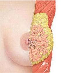 Fibrose mamária: causas e consequências da patologia, princípios de tratamento Fibrose difusa das glândulas mamárias