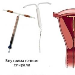 Candidíase crônica (candidíase) Vantagens e desvantagens dos dispositivos intrauterinos